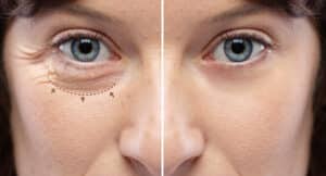 Before and after comparison of a woman’s eye area showing the results of rejuvenation treatment for wrinkles and crow’s feet, with surgical markings indicating blepharoplasty zones