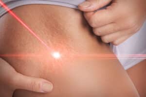 Close-up of a woman’s hips with visible stretch marks undergoing a laser removal treatment session for smoother skin