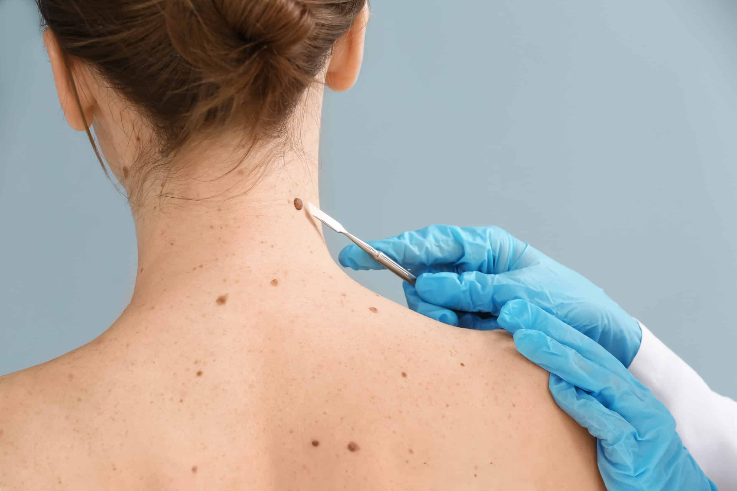 A Mohs surgeon examining a patient with skin cancer