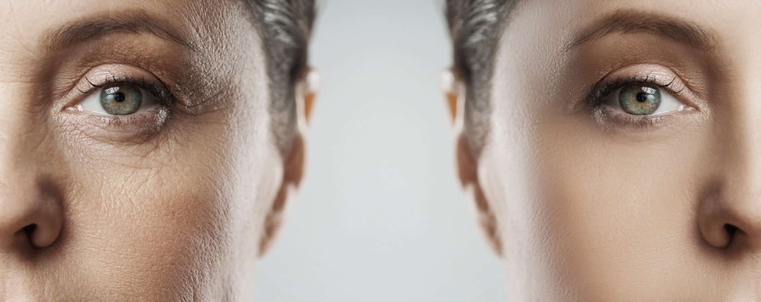 Comparison of female face before and after rejuvenation treatment, showing smooth skin and anti-aging results